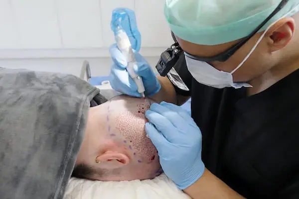 FUE hair transplant img 4