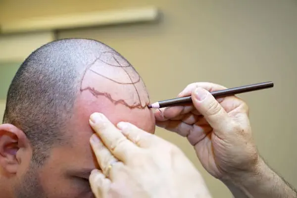 FUE hair transplant img 5