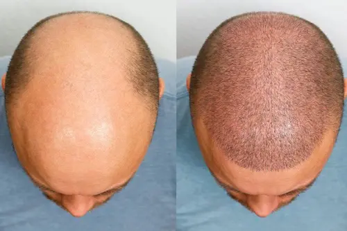 FUE hair transplants img 2