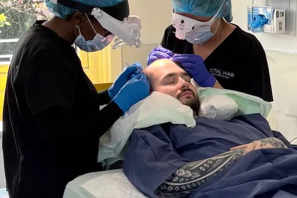 Fue hair transplant img 3