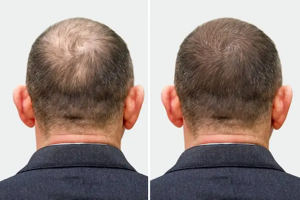 Hair Loss Management img 1