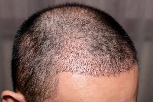 Hair Loss management img 2