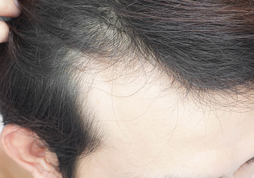 Total Hair Restoration parting hair to show bald spot