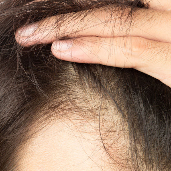 Total Hair Restoration closeup of hairline
