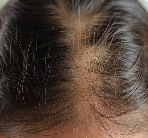 Total Hair Restoration closeup of head with hairloss