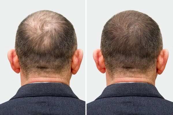 Hair Loss Management img 1