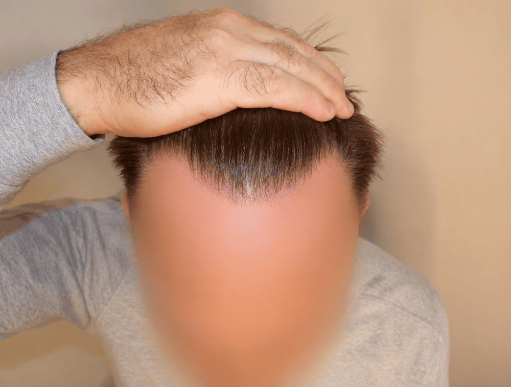 before Hair Transplant | Total Hair Restoration