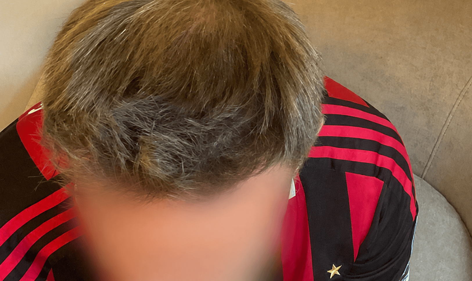 After Hair Transplant | Total Hair Restoration