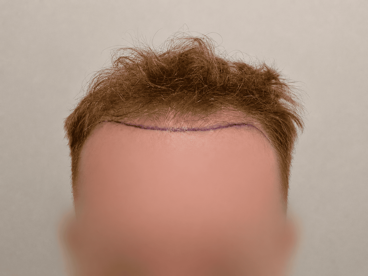 before Hair Transplant | Total Hair Restoration