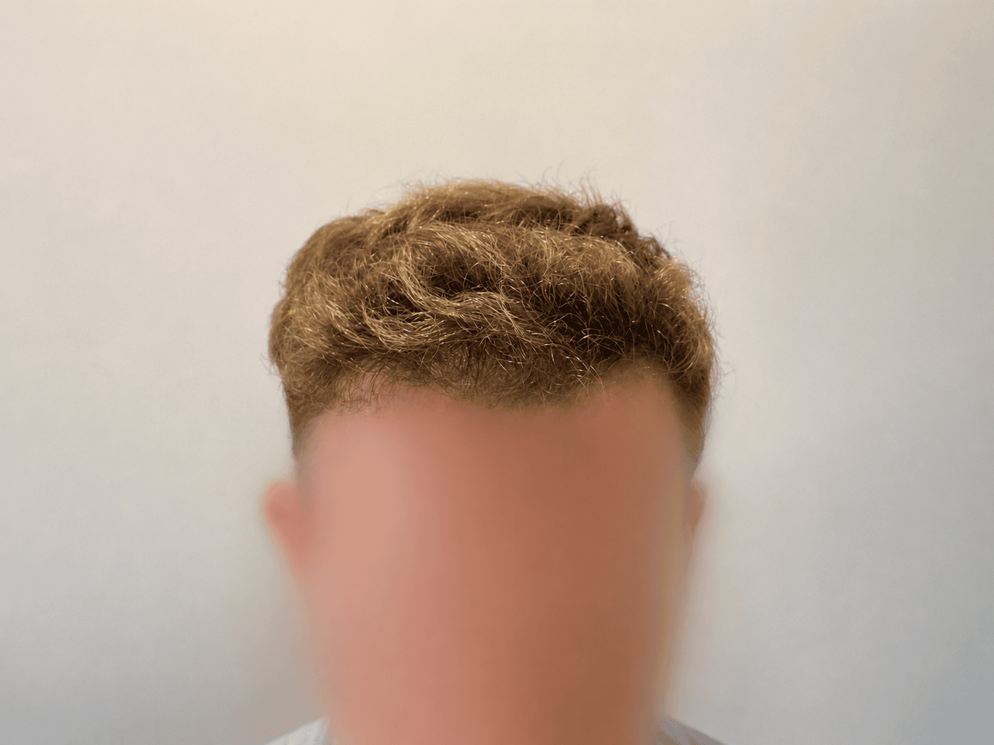 After Hair Transplant | Total Hair Restoration