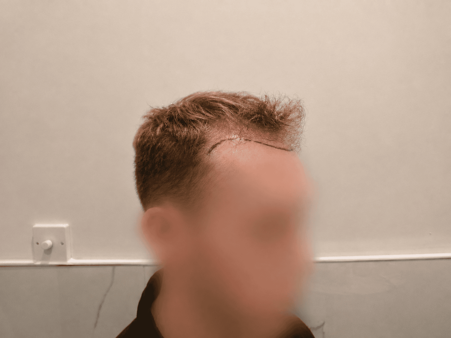 before Transplant | Total Hair Restoration