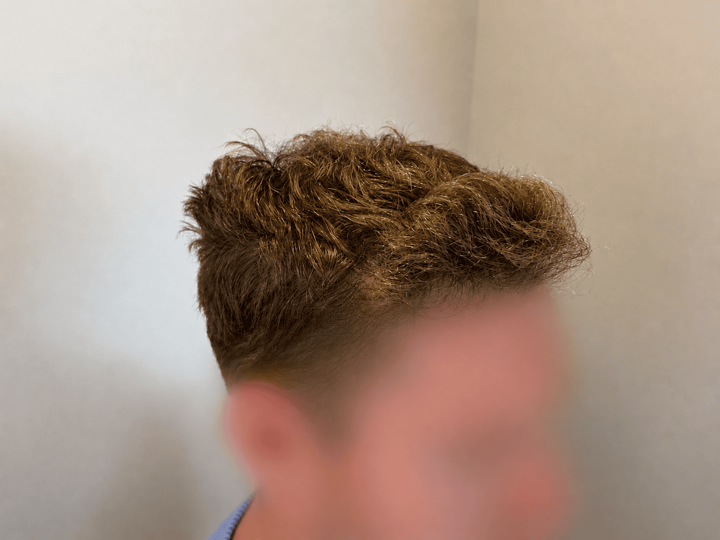 After Hair Transplant | Total Hair Restoration