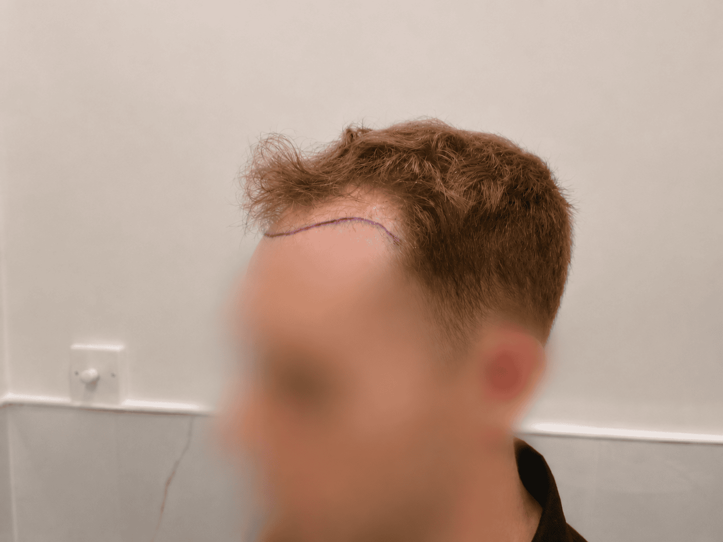 before Transplant | Total Hair Restoration
