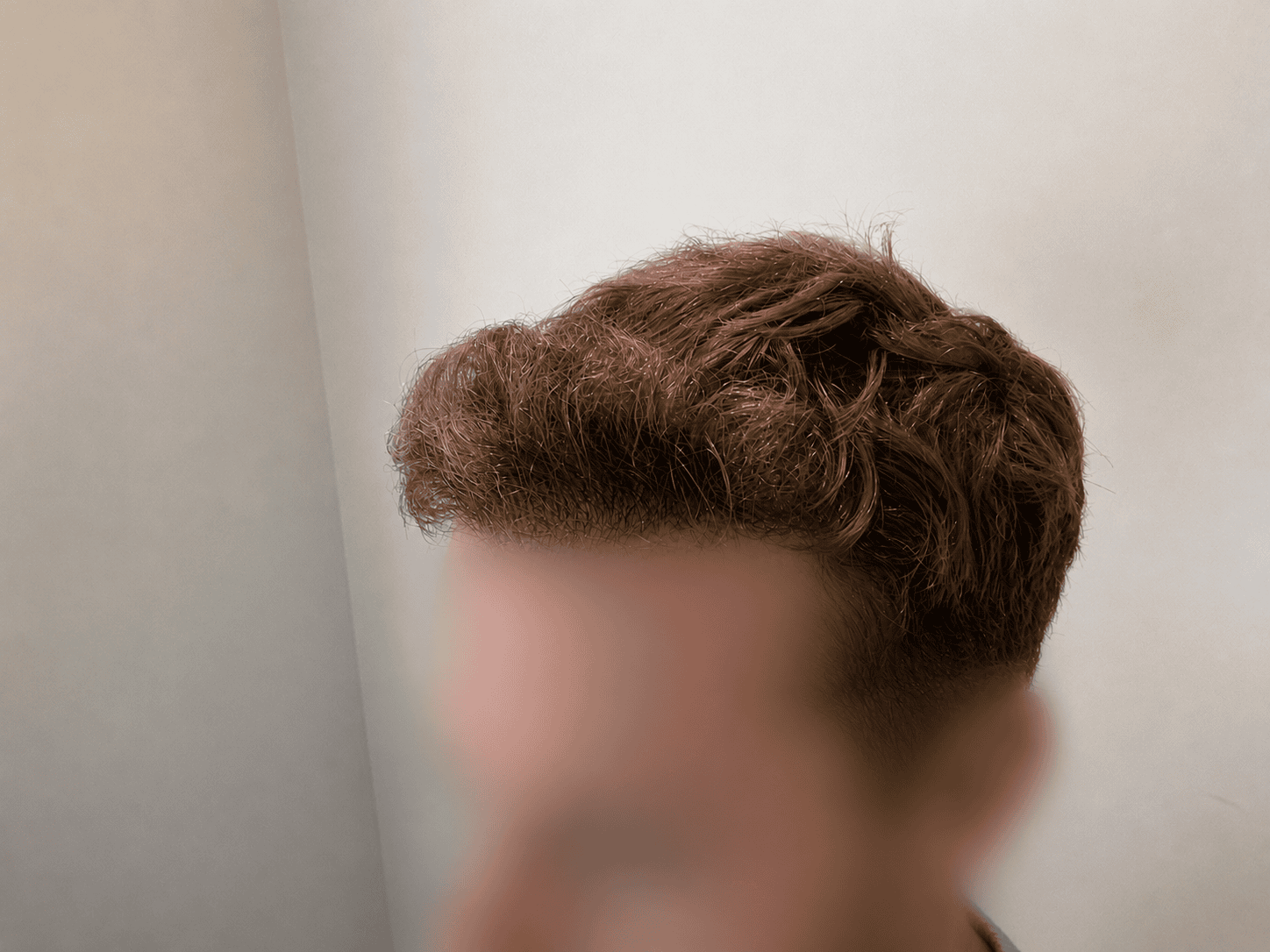 After Hair Transplant | Total Hair Restoration