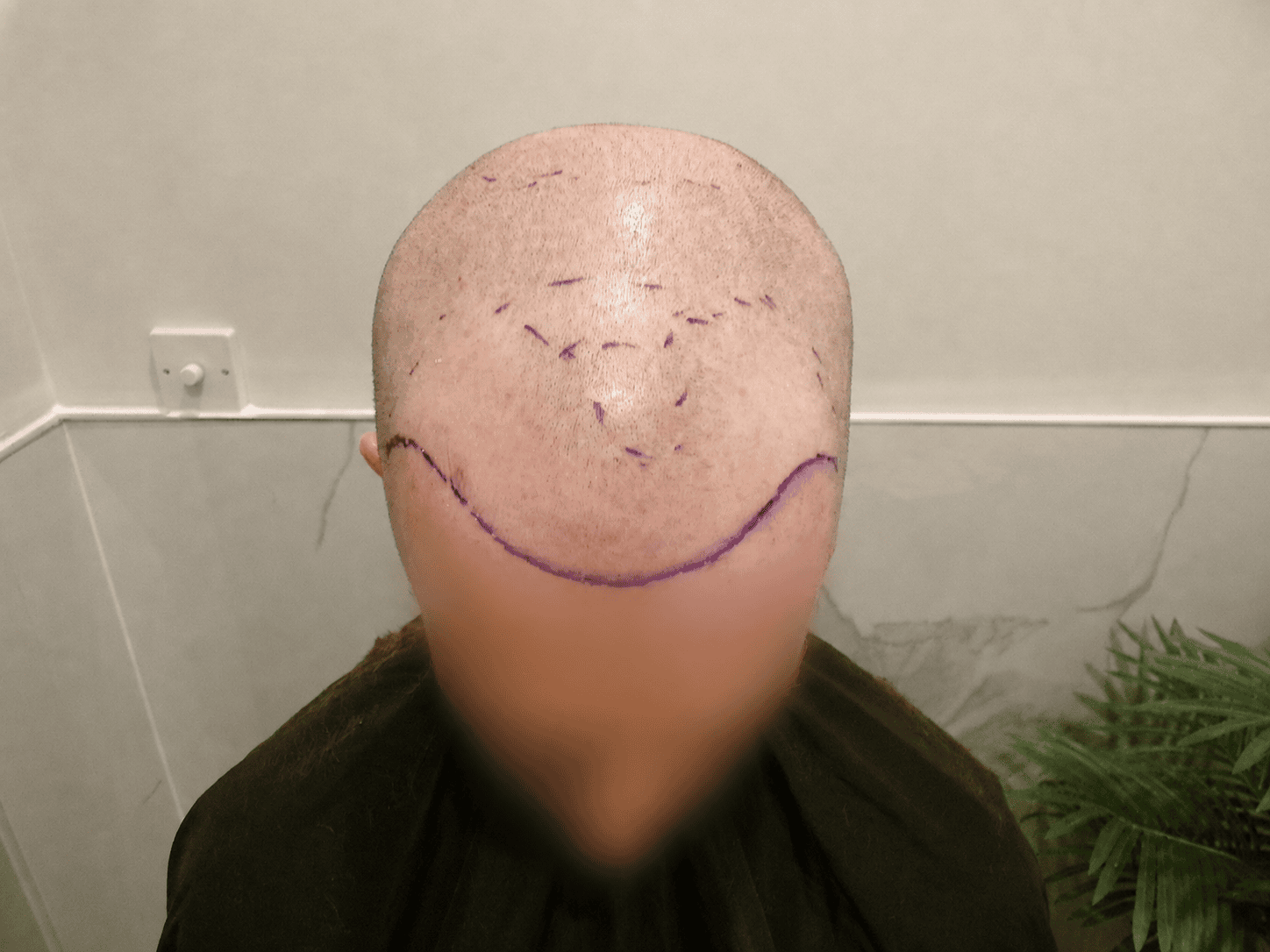 Before Slider Hair Transplant | Total Hair Restoration