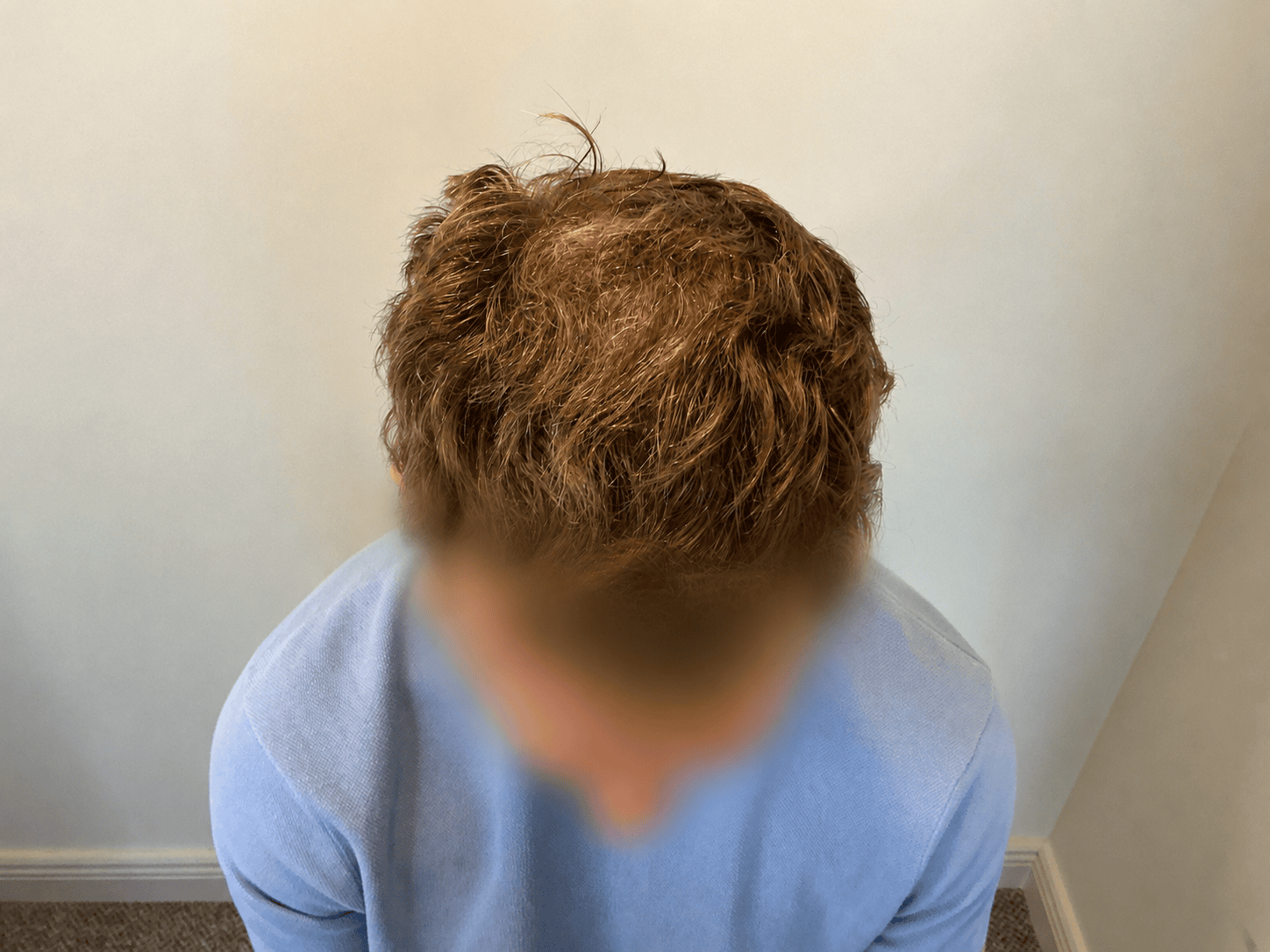 After Slider Hair Transplant | Total Hair Restoration