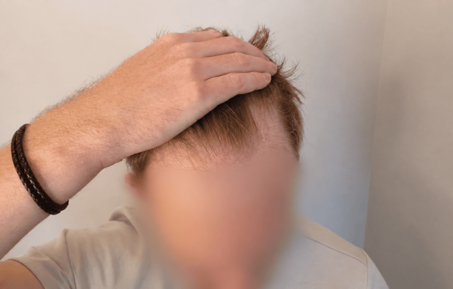 Before Hair Transplant | Total Hair Restoration
