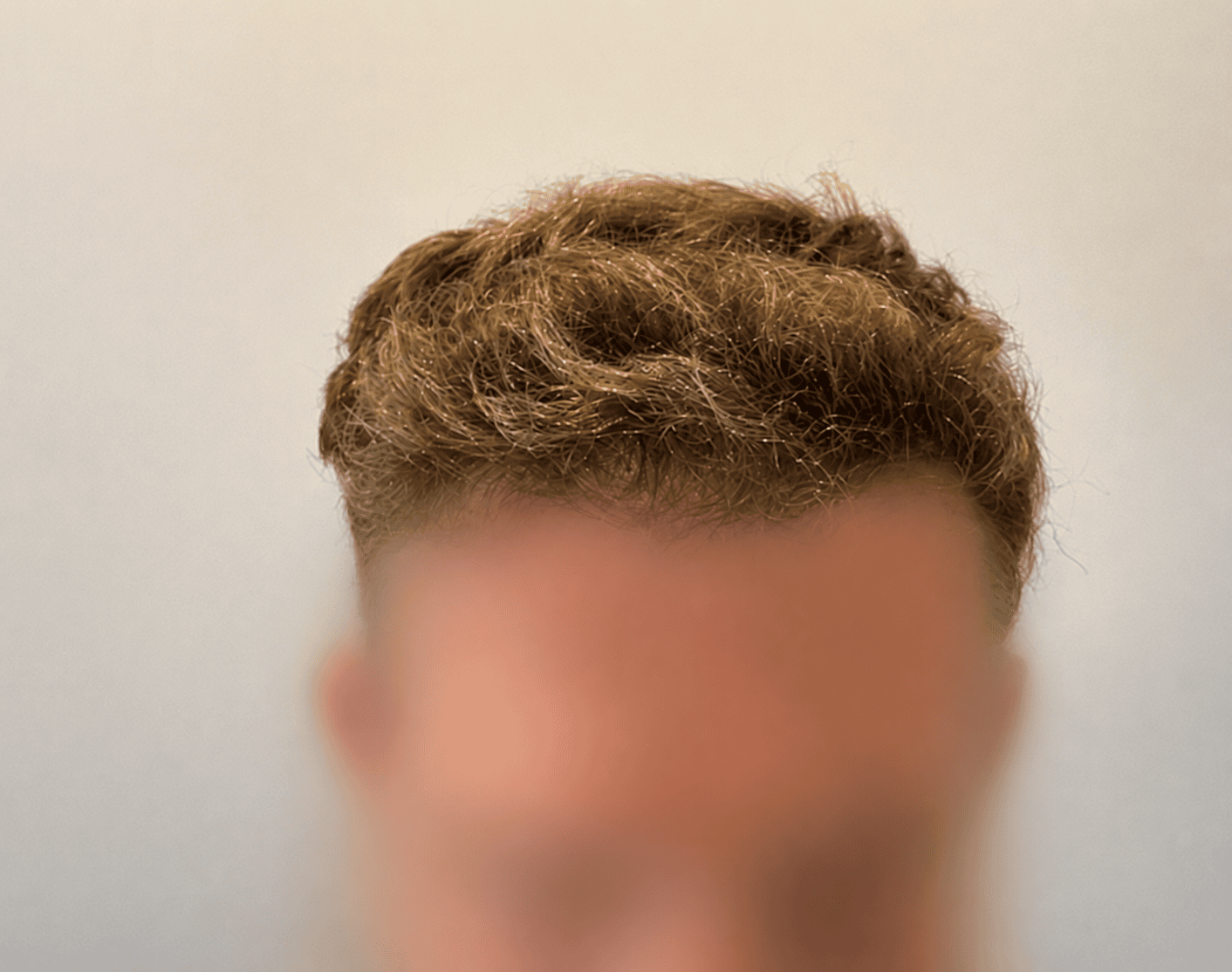 After Hair Transplant | Total Hair Restoration