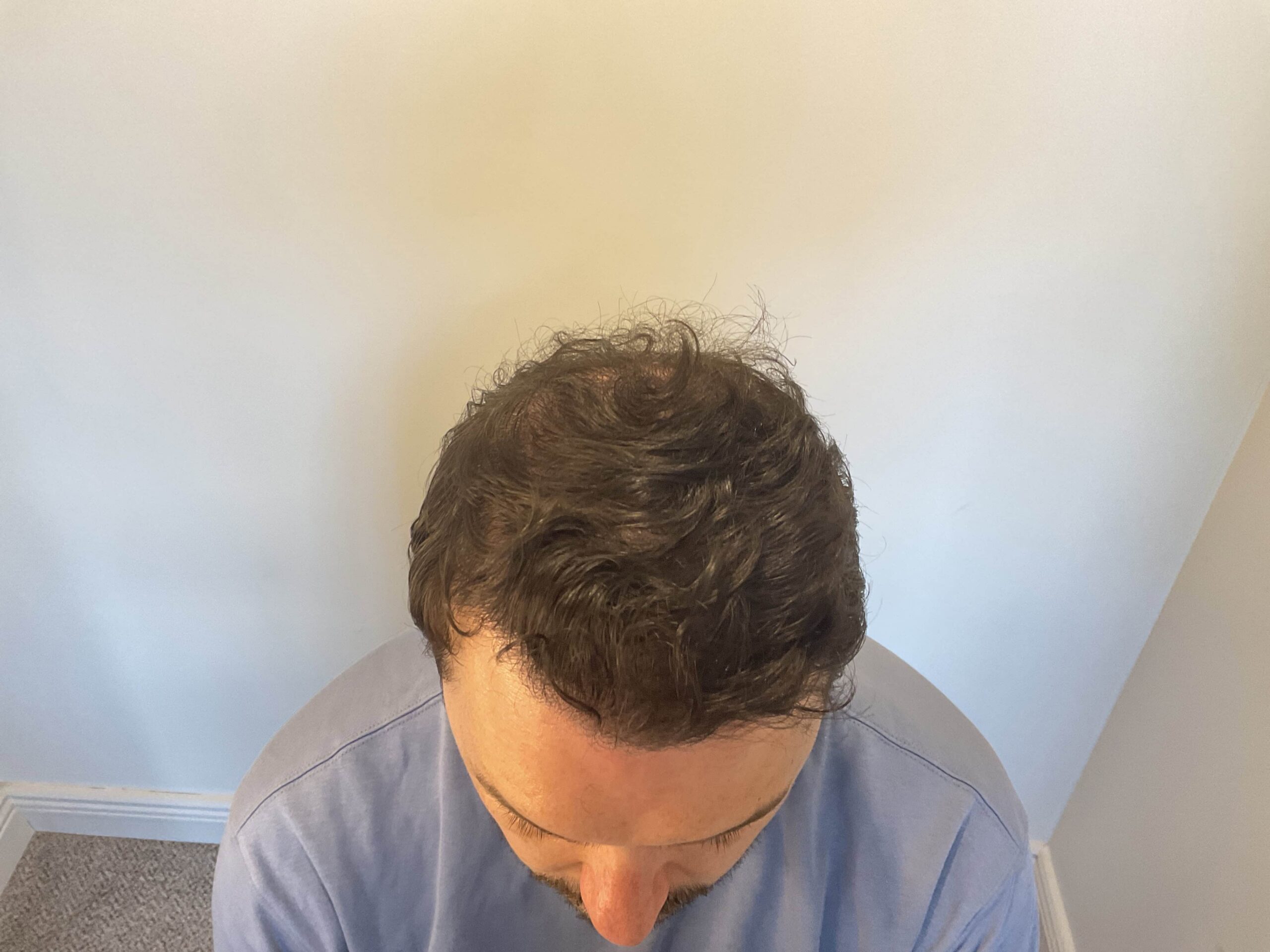 After Hair Transplant | Total Hair Restoration