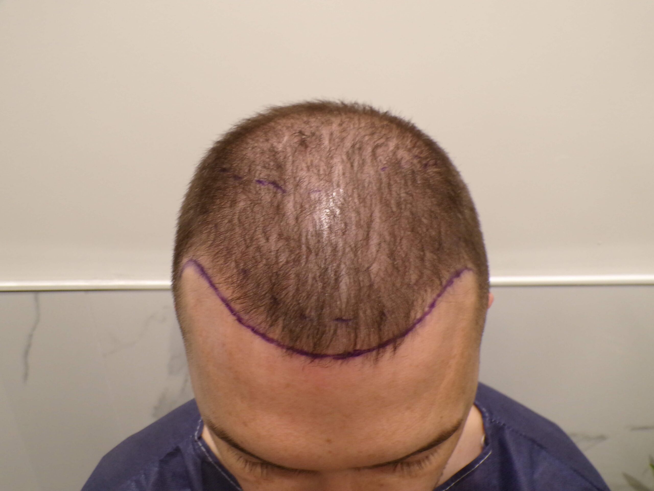 Before Transplant | Total Hair Restoration