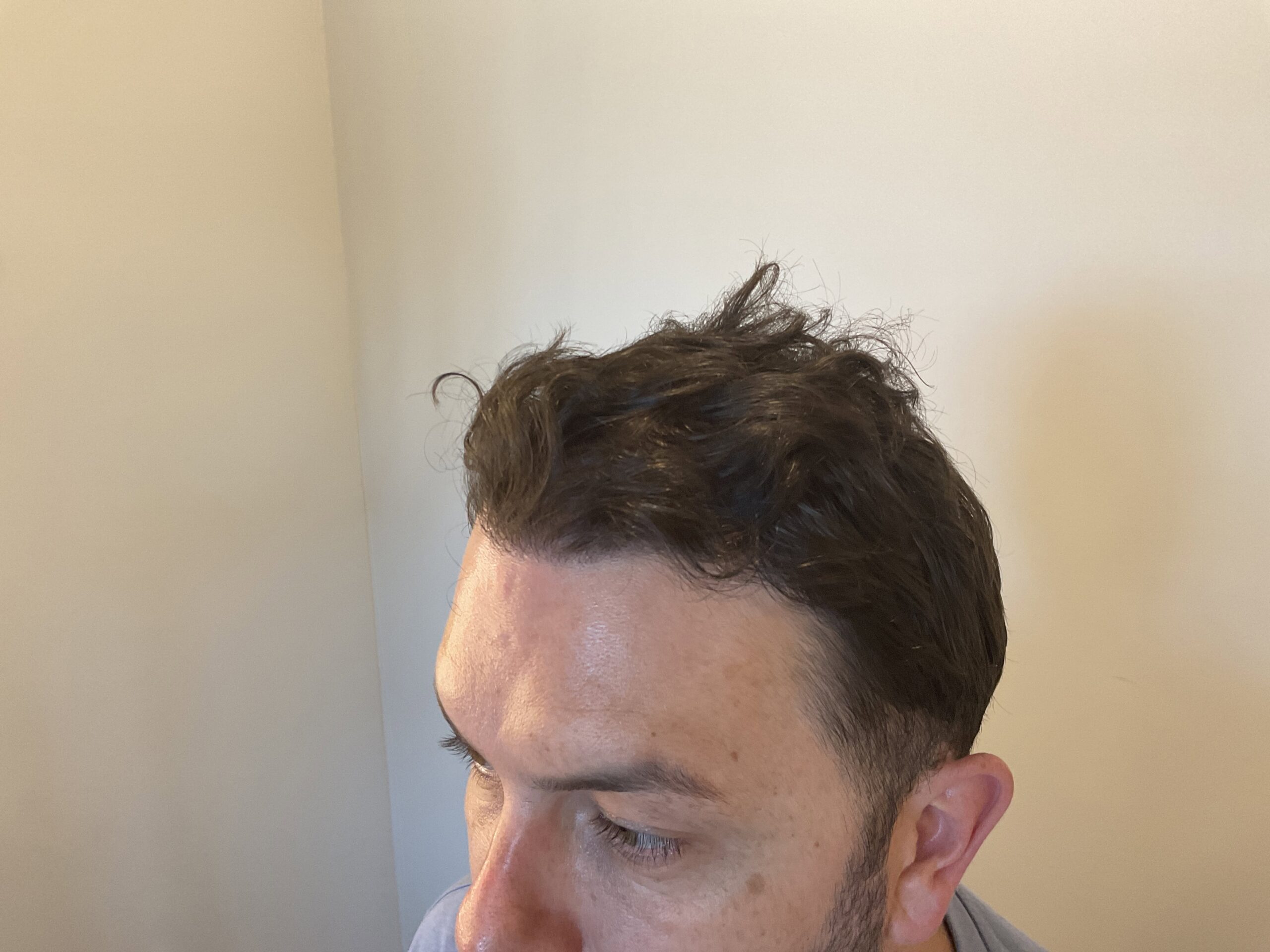 After Hair Transplant | Total Hair Restoration