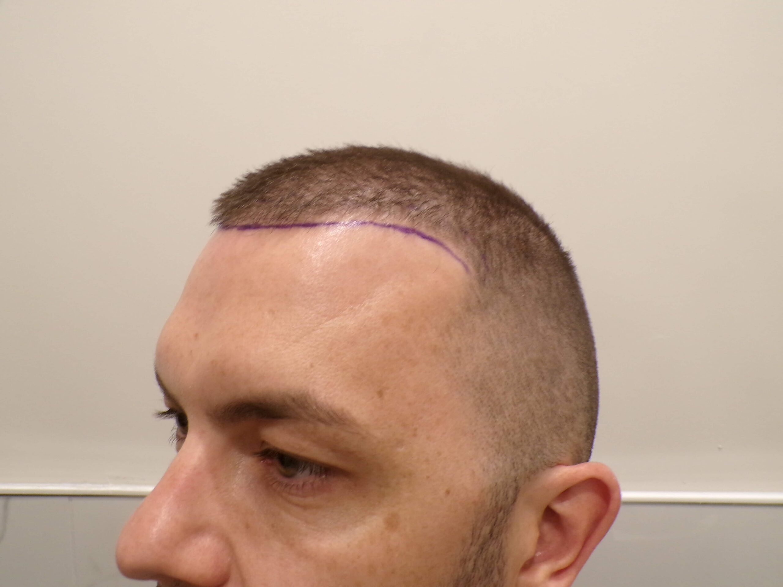 Before Hair Transplant | Total Hair Restoration