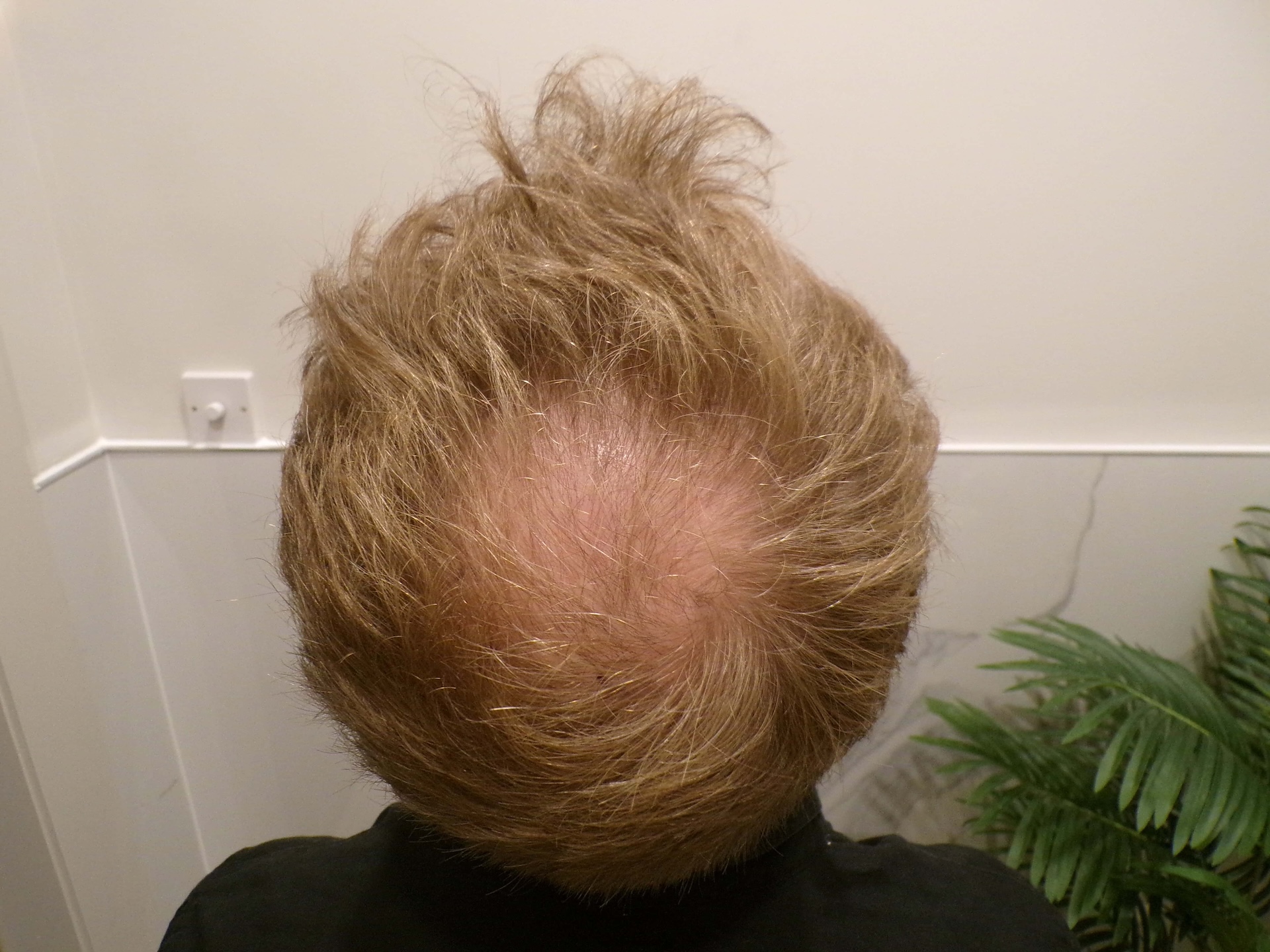 Before Hair Transplant | Total Hair Restoration