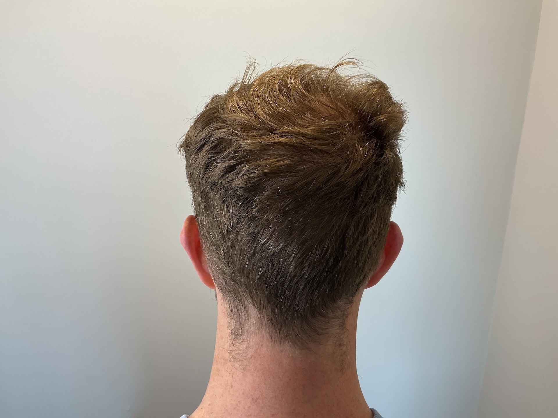 After Hair Transplant | Total Hair Restoration