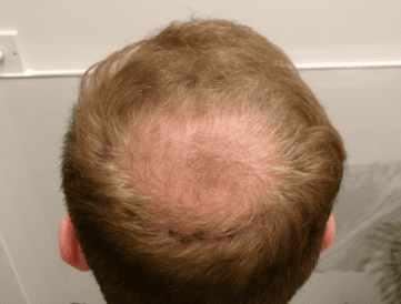 Before Hair Transplant | Total Hair Restoration