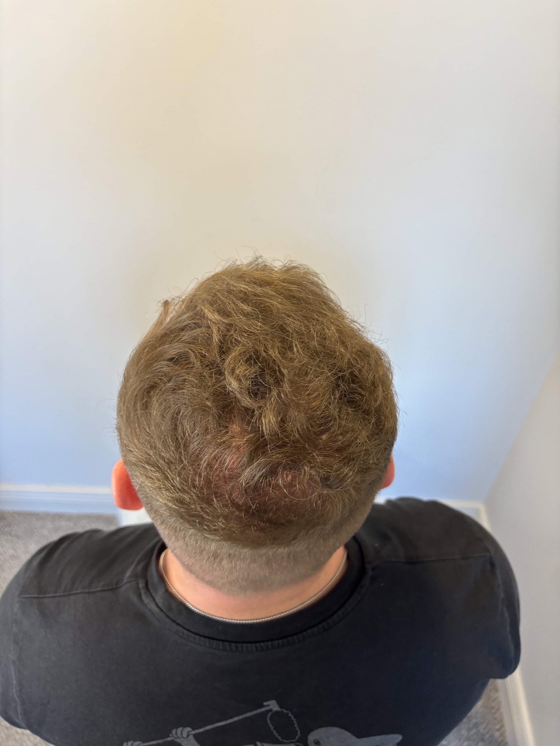 After Hair Transplant | Total Hair Restoration