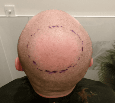 Before Hair Transplant | Total Hair Restoration