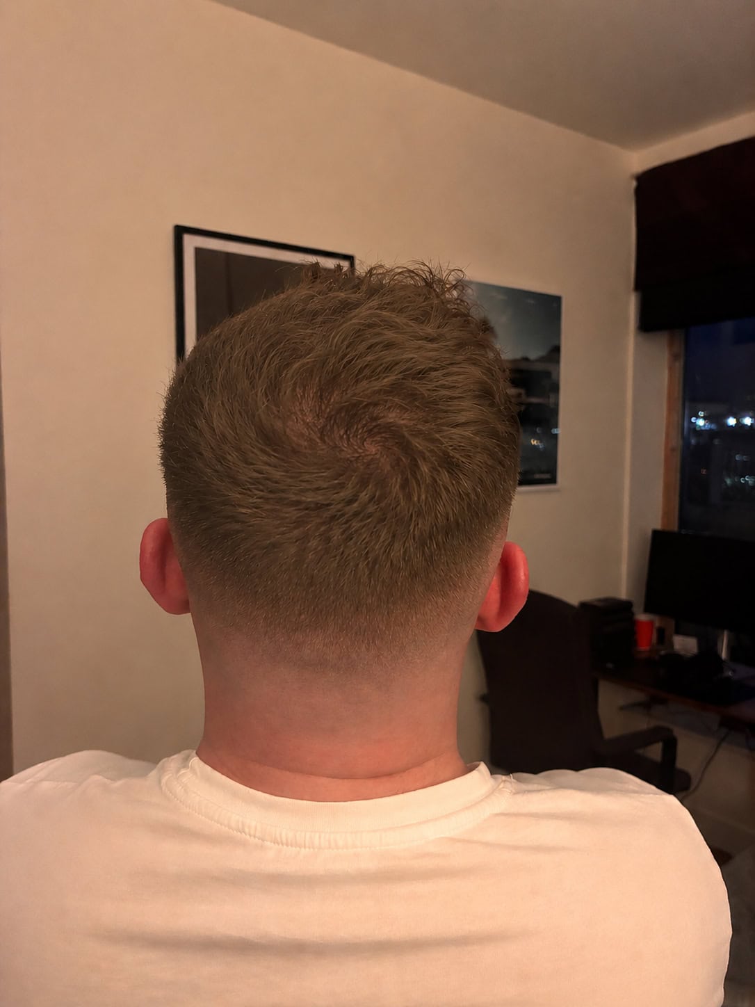 After Hair Transplant | Total Hair Restoration